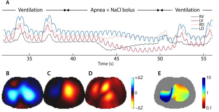 Illustration of ventilation-perfusion assessment using Sciospec’s EIT device for real-time lung monitoring.